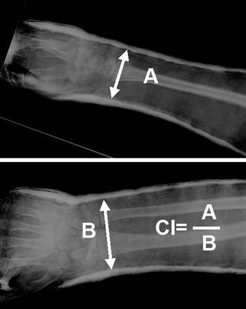 Distal Radius Fractures - Pediatric - Pediatrics - Orthobullets
